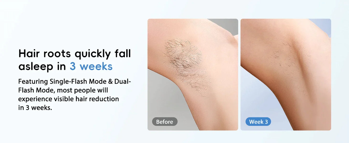 FlashQueen 5.2 – Unlimited IPL Laser Hair Removal Device with 22J Power & Lightning-Fast 0.8s Flashes for Face, Bikini & Body